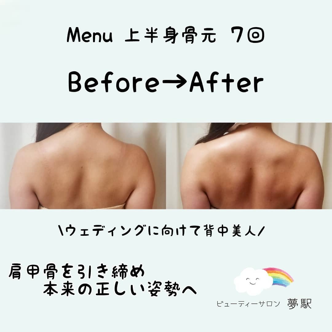 ウェディングに向けてのお客様💒
猫背だと呼吸が浅くなり太りやすくなります。
広がっていた肩甲骨を元の位置に戻し、肩甲骨が閉まることで背中に溝がでて綺麗なラインになります✨ (回数7回)
 ̄ ̄ ̄ ̄ ̄ ̄ ̄ ̄ ̄ ̄ ̄ ̄ ̄ ̄ ̄ ̄ ̄ ̄ ̄ ̄ ̄ ̄ ̄ ̄ ̄
🌟名古屋店 ご予約プロフィール画面リンクのホットペッパービューティーから🌟
HP📳www.yumeeki.com
【ビューティーサロン夢駅】
名古屋本店/福岡店/銀座店(※2010年~のご案内となっております。)
 ̄ ̄ ̄ ̄ ̄ ̄ ̄ ̄ ̄ ̄ ̄ ̄ ̄ ̄ ̄ ̄ ̄ ̄ ̄ ̄ ̄ ̄ ̄ ̄ ̄
#名古屋エステ#小顔#名古屋痩身#コルギ#名古屋コルギ#二重顎#bnls#ウェディングエステ#姿勢#頬肉#猫背改善#花嫁#名古屋小顔#法令線#猫背#ユルコル#脂肪吸引#姿勢改善#vライン#肩甲骨はがし#二の腕#ほうれい線#弛み#肩甲骨#ウェディング#名古屋骨気#名古屋矯正#たるみ#二の腕痩せ#背中